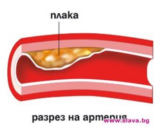 СВАЛЯТ ХОЛЕСТЕРОЛА БЕЗ ЛЕКАРСТВА