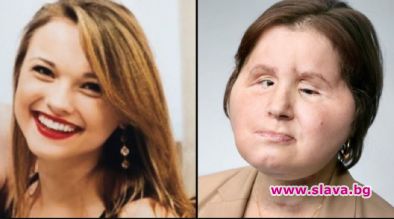 Ето го най-младото момиче с присадено лице в света