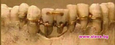 Зъболечение на 4000 години