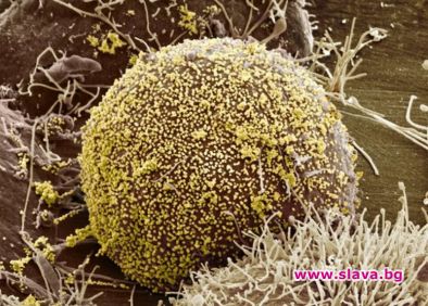 Излекуваха жена от H. I. V. с ново лечение