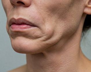 ОК-хранително поведение вместо увиснали, а после по-дебели след Оземпик: Как?