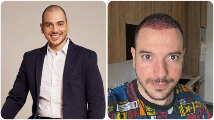 Цитиридис си присади коса